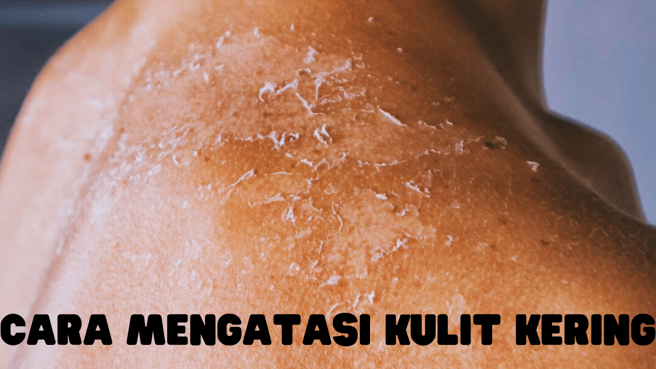 Cara Mengatasi Kulit Kering